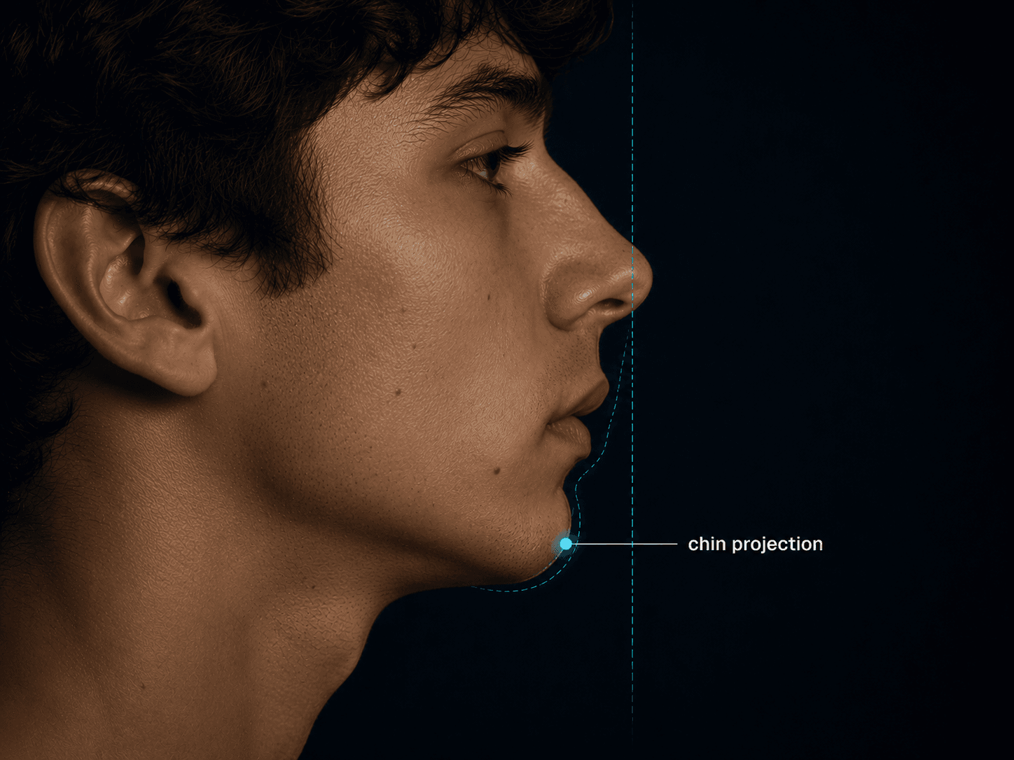 Chin projection diagram